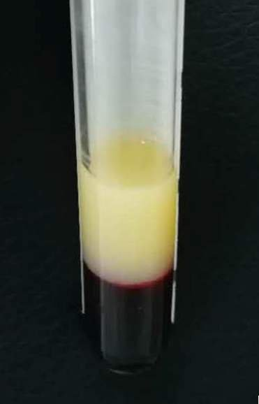 小伙送医抢救抽出奶白色血液：夜晚暴饮暴食 体内甘油三酯过高